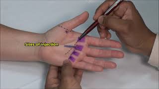 Flexor Tendonitis Hand Injection [upl. by Helbonnah681]