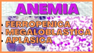 Anemia Ferropenica Megaloblastica y Aplasica FISIOPATOLOGIA [upl. by Llerrehc996]