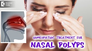 NASAL POLYPS  Best Homeopathic Treatment  Dr V Bhagyalakshmi  Doctors Circle [upl. by Yasmin]