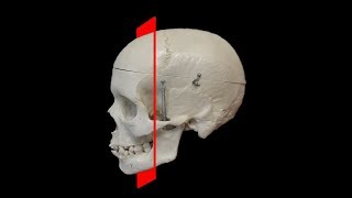 How to Read CT Sinus Scans  A Laypersons Guide [upl. by Jutta579]