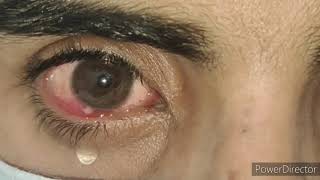 Phlyctenular keratoconjunctivitis CC34 [upl. by Ormand]