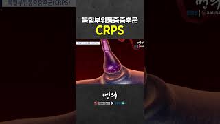 악마의 통증 인간이 느끼는 최악의 고통 CRPS [upl. by Enneibaf83]