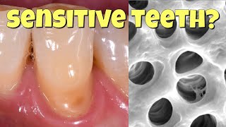 Why teeth get sensitive and how to fix it [upl. by Saeger]