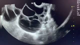 OVARIAN HYPERSTIMULATION SYNDROME ultrasound ovariancyst sonography radiology [upl. by Hinda]