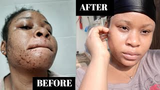 How I Got Rid of STUBBORN ACNE amp DARK SPOTS Naturally [upl. by Geaghan]