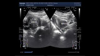 Anterior wall Uterine Fibroids Ovarian Mass and Hemorrhagic Ovarian Cyst [upl. by Lawan]