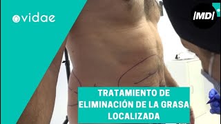 Cómo eliminar la grasa localizada [upl. by Eelrahs640]