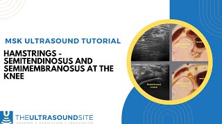 Hamstring ultrasound  Semimembranosus and Semitendinosus tendons and using Anistropy [upl. by Adaven802]