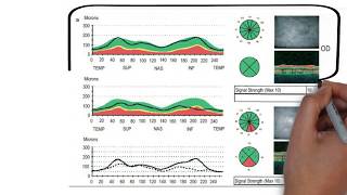 OCT  Ocular Coherence Tomography  Dr Alan Mendelsohn [upl. by Ioyal]