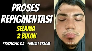 Proses Repigmentasi Sampai Vitiligo Hilang Menggunakan Protopic dan Melvit Cream Selama 2 bulan [upl. by Donatelli]