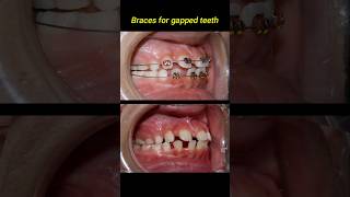 Braces for gapped teeth braces orthodontist niengrang [upl. by Amik]