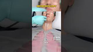 Bronchoscopy is a procedure that allows doctors to examine the lungs using a BRONCHOSCOPE🫁 [upl. by Logan]