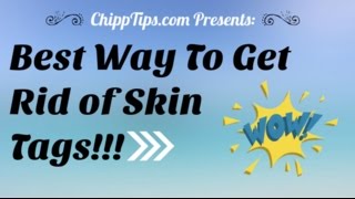 How to Remove Skin Tags at Home  Fastest Way to Remove Skin Tags Yourself [upl. by Korwin]