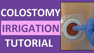 Colostomy Irrigation Procedure Care  Ostomy Enema Nursing  Stoma Cleaning [upl. by Isia]