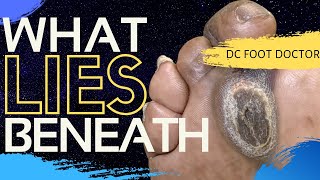 How to treat foot corn amp warts  Dr Rasya Dixit [upl. by Nivrek]