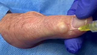 Ganglion Cyst Jelly Doughnut Hole Extraction [upl. by Cordelie201]