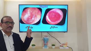 Granular myringitis English Patient teaching programme [upl. by Moriarty]