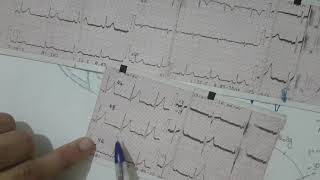 formation ECG 17 interprétation dun ecg normal [upl. by Kevin166]