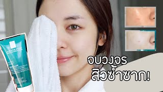 REVIEW ทำไงยังไงไม่ให้เกิดสิวซ้ำซาก สิวอักเสบ wLa RochePosay Micro Peeling Gel  Babyjingko [upl. by Ayamat]