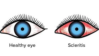 ScleritisEpiscleritis  in very easy way eyedisorders scleritis episcleritis shalakyatantra [upl. by Lorusso615]