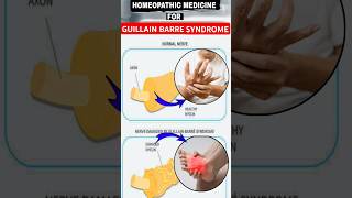 Guillain Barre Syndrome gbs  guillain barre syndrome treatment homeopathy  guillainbarresyndrome [upl. by Oicnevuj]