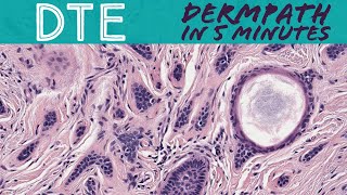 Desmoplastic Trichoepithelioma benign mimic of skin cancer BCC MAC Dermpath in 5 Minutes [upl. by Verla]