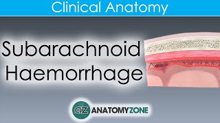 What is Subarachnoid Haemorrhage  Clinical Anatomy [upl. by Thorner]