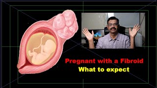 Fibroids Treatment options by Dr Meenakshi at Apollo Spectra Hospitals in Tamil [upl. by Agace]