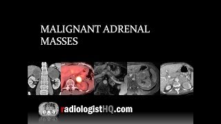 Malignant Adrenal Masses [upl. by Sillig]