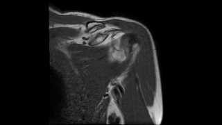 ALPSA laesion of the shoulder  complete MRI examination [upl. by Tawney]