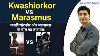 KWASHIORKOR VS MARASMUS difference  Malnutrition disease in child  Full detail in hindi [upl. by Campman]