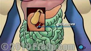 Gallbladder Removal Laparoscopic PreOp® Patient Education Feature [upl. by Mcneely]