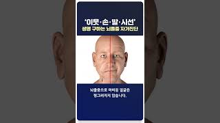 🧠치매 뇌졸중 파킨슨 심장질환 자가진단🧠발병 10년전부터 몸에 생기는 신체증후들  안검황색종 귓볼주름 심한입마름 부종 난청 수족냉증 탈모 손떨림 I 루이빈치과 류지헌 원장 [upl. by Nnylsaj]