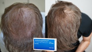 My Finasteride Results After 1 Year [upl. by Castillo302]