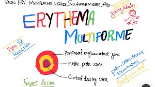 Erythema Multiforme EM causes symptoms treatment  skin disorder [upl. by Inverson]