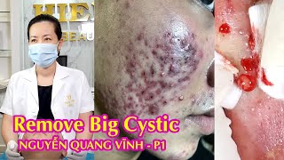 Remove Big Cystic  Điều trị mụn hiệu quả số 1 Hiền Vân Spa  Nguyễn Quang Vĩnh Part 1  525 [upl. by Dorinda798]