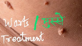 warts  मस्से  permanent treatment [upl. by Ahseinat205]