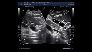 Multiple Polyps in the Gallbladder [upl. by Anitroc161]