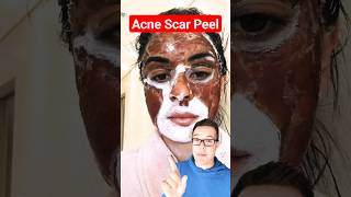 DRAMATIC CHEMICAL PEEL  Phenol Peel For Acne Scars shorts [upl. by Tnerb546]