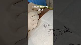 Suture RemoveLSCSMedical With Sanju [upl. by Waddle472]