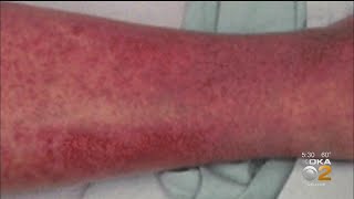 Why Does Coronavirus Cause Harmful Rashes [upl. by Atterrol243]