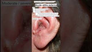 Acute otitis externa [upl. by Lull656]