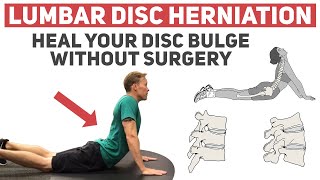 How to Heal Your Disc Herniation Without Surgery [upl. by Yllil]