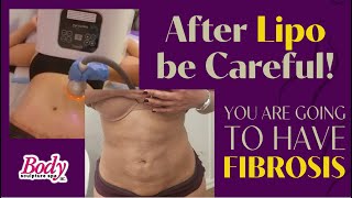 Postliposuction fibrosis [upl. by Cinderella45]