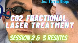 My 2nd and 3rd Sessions Before Results Co2 Fractional Laser Acne Scar Treatment in Cebu Philippines [upl. by Pierson233]