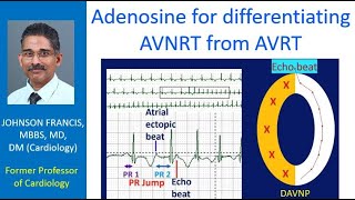 Adenosine for differentiating AVNRT from AVRT [upl. by Harias]