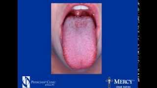 How to Recognize Throat Cancer Symptoms  Throat Cancer Information [upl. by Anaeed]