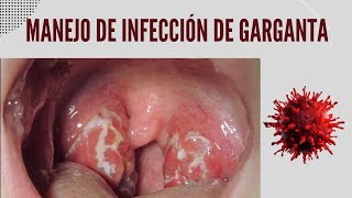 Manejo de la Infección y dolor de garganta [upl. by Soll]