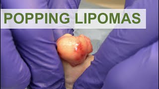 Popping Lipomas  Dr Derm [upl. by Harod]