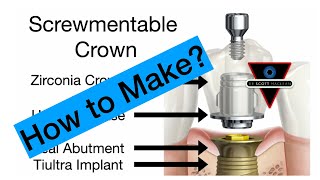 How to make  ScrewMentable Implant Crown  On1 TiBase Abutment [upl. by Bolen]